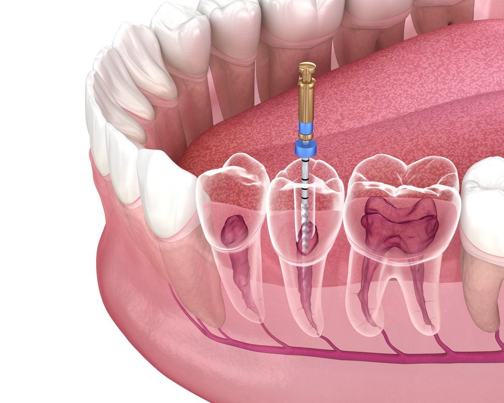 Root Canal Treatment (RCT)